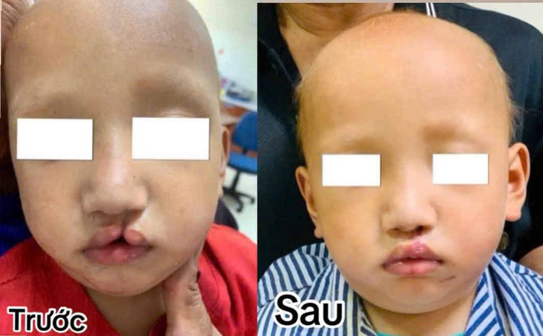 SỨT MÔI BẨM SINH – PHÁT HIỆN SỚM, ĐIỀU TRỊ HIỆU QUẢ