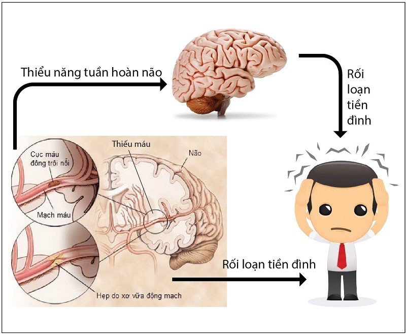 RỐI LOẠN TIỀN ĐÌNH